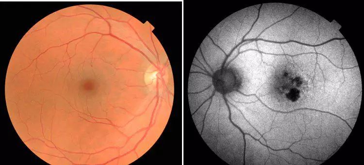 科學家注射病毒到眼睛里反轉了老化眼盲的癥狀！