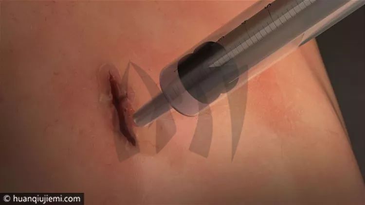 國外發明醫療用膠水，60秒就能把傷口、器官黏起來！