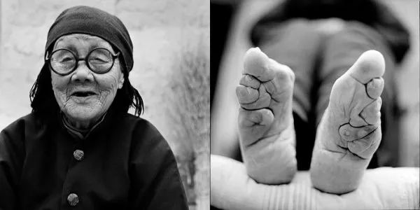 古代傳統極端纏足文化照片，X光看起來太可怕！