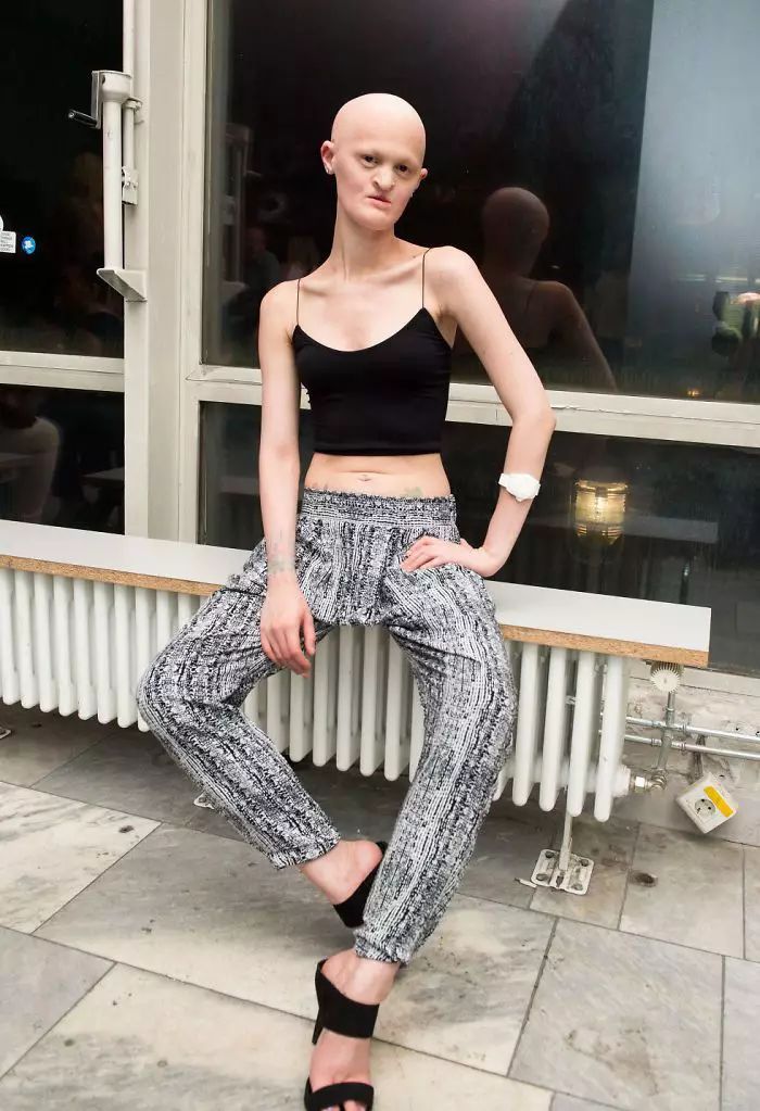 28歲患有罕見基因異常疾病的女模打破了眾人對時尚的印象