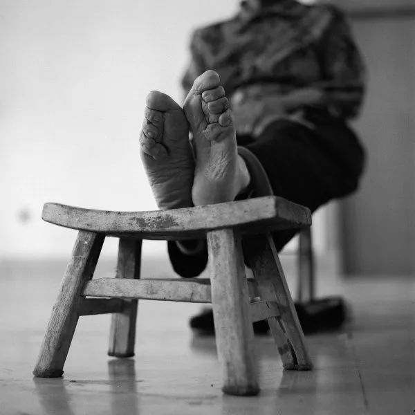 古代傳統極端纏足文化照片，X光看起來太可怕！